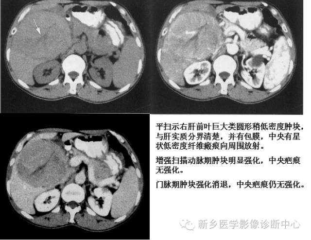 收藏 | 肝脏富血供病变，应想到这16种疾病
