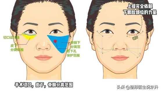 40岁左右，有眼袋、轻度法令纹，更适合做眼袋切口面中部提升