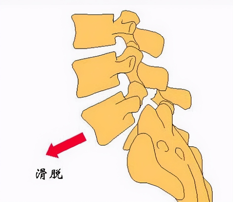 路医生说丨&ldquo;腰椎滑脱&rdquo;，究竟是个什么鬼，是腰椎脱位了么？
