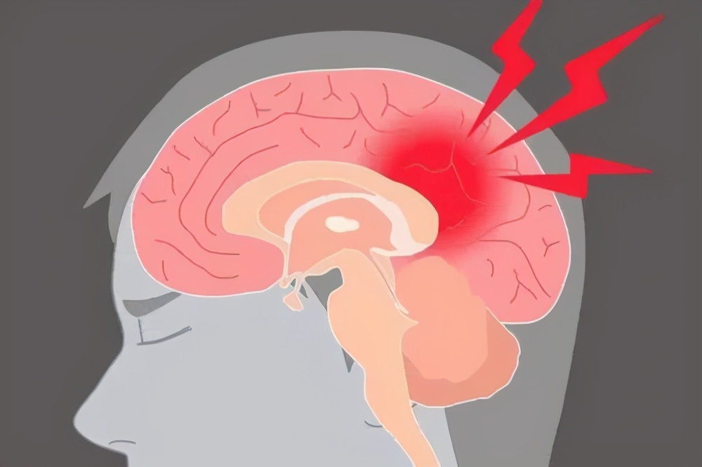 老年人如何预防脑中风的发生?这5件事要早知道
