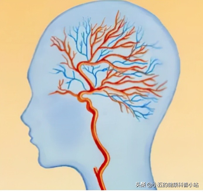 改善供血？修复神经？聊一聊防治脑梗死的中成药&mdash;&mdash;华佗再造丸