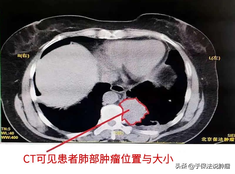 左肺下叶肿瘤，经缓释库超微创靶向治疗，生存超过6年