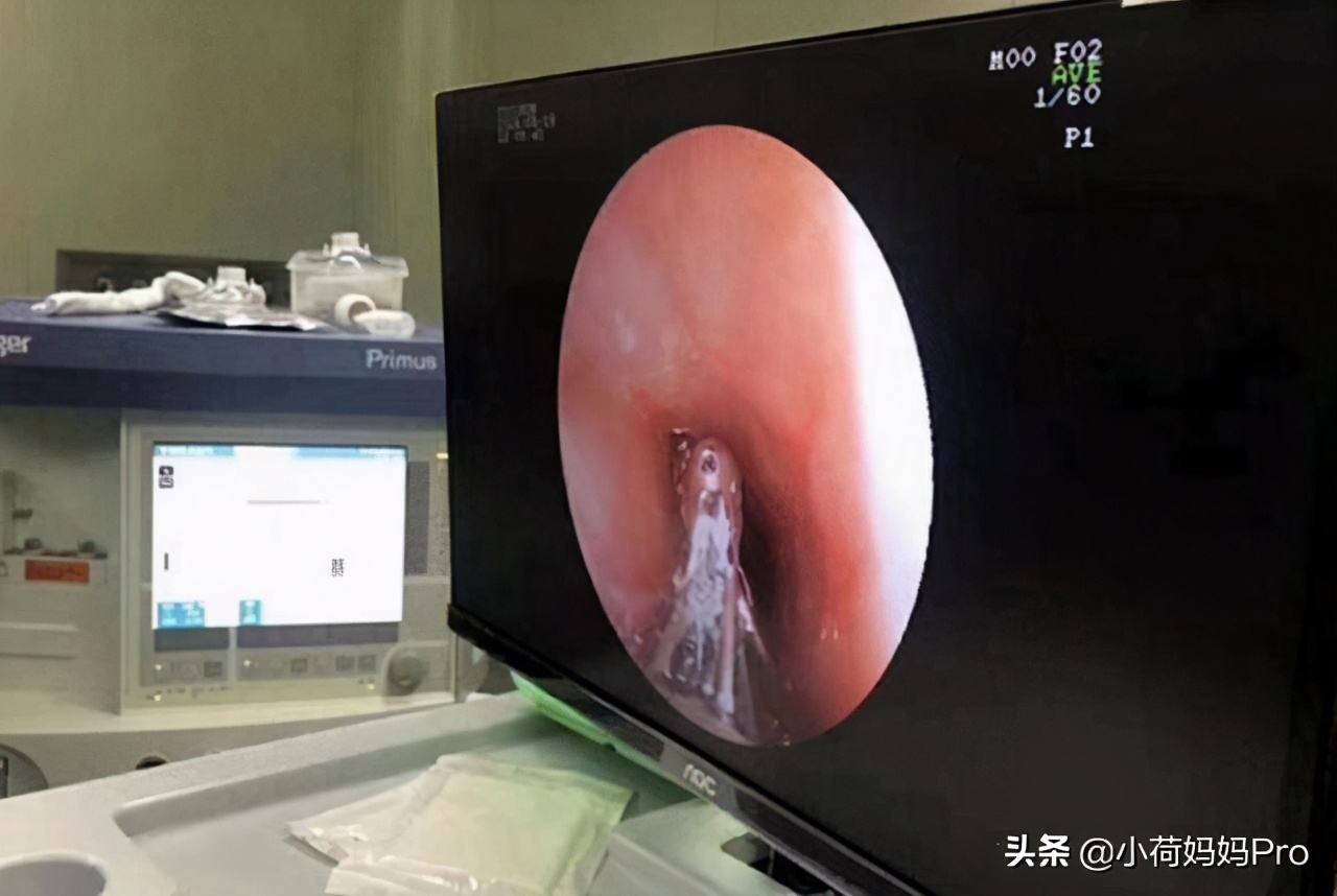 男童胃里发现一团“胶”，家长眼里的好零食，制作环境犹如垃圾场