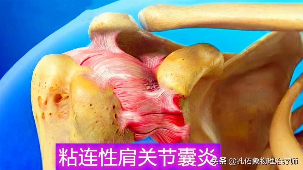 出现肩膀疼痛、活动困难就是肩周炎吗？医生辟谣，带您了解肩痛