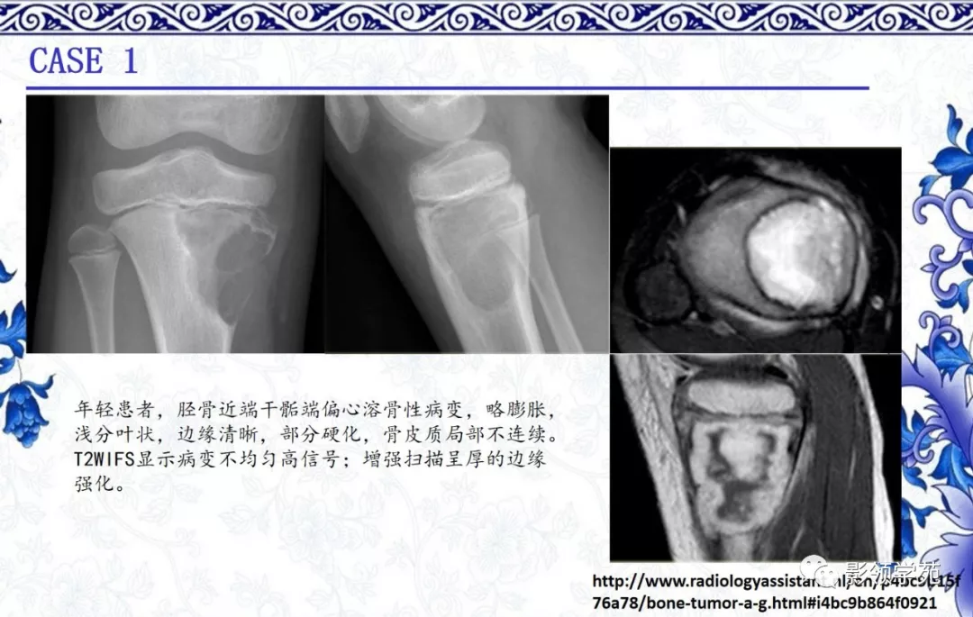 7种常见的软骨源性肿瘤的影像表现