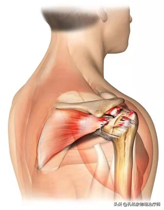 肩膀疼痛不要再认为是肩周炎了医生详细告知您这9个常见病因走出误区