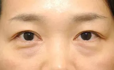 如何祛除眼袋黑眼圈?靠谱的方法在这里