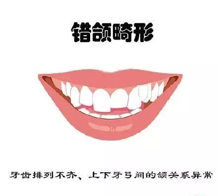 什么牙需要矫正呢？