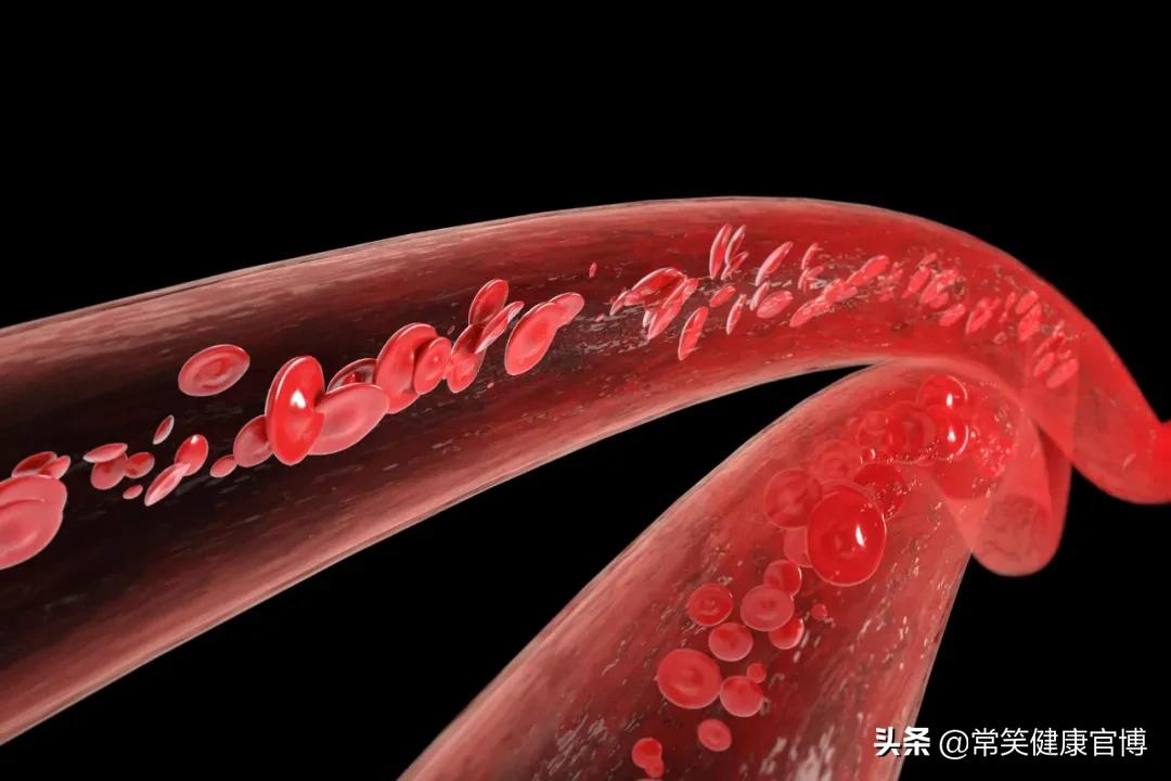命有多硬,很大程度上取决于血管硬不硬!硬掉的血管能再变软吗?