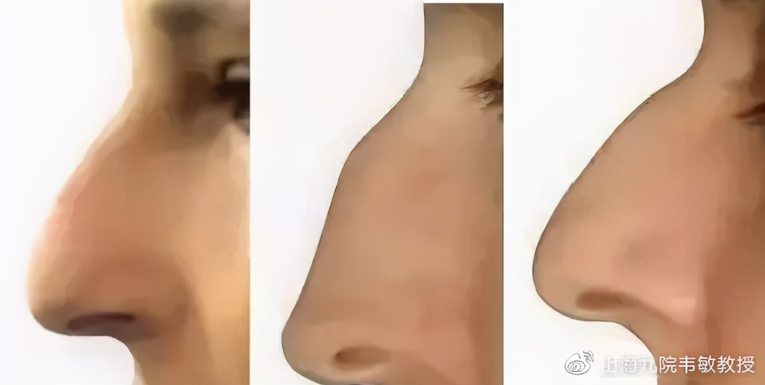 影响美观与气质的鹰钩鼻如何矫正 鼻部整形 鼻部整形