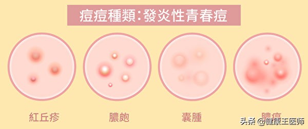 你的痘痘是哪种 严重吗？1篇看懂痘痘种类