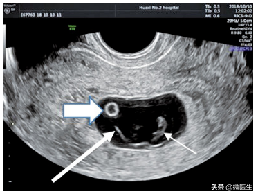 怀孕后早孕期B超图怎么看？医生详解，图文并茂