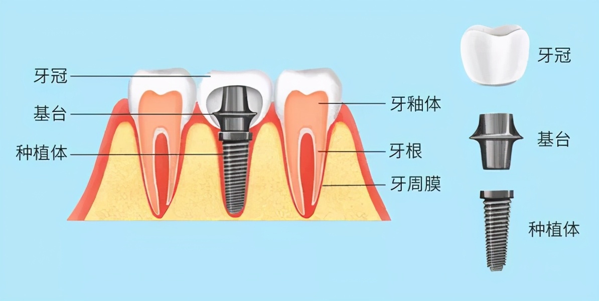 种牙后就不用管了？种植牙会“坏”吗？