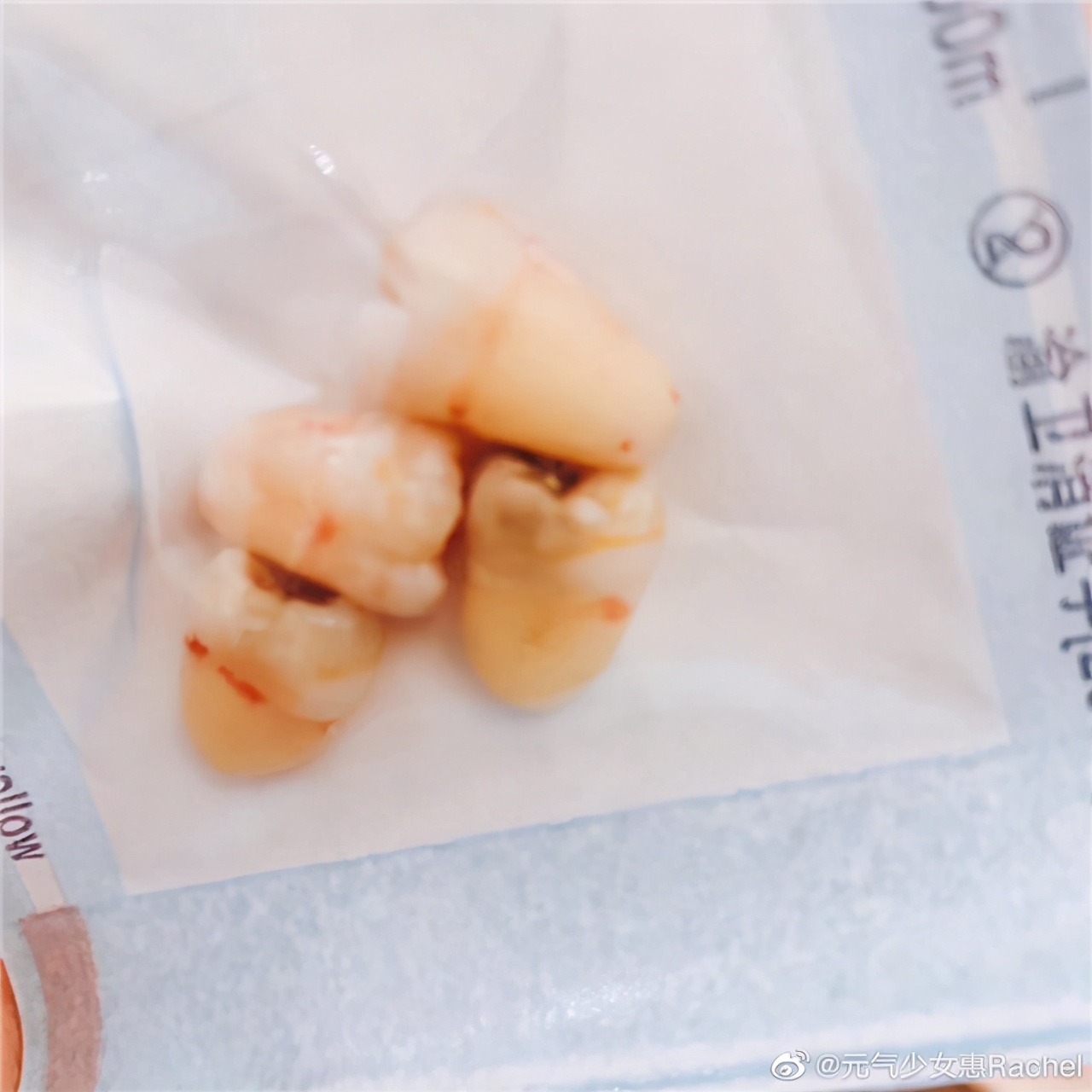 Champion of women's volleyball Olympic Games is a firm person! Husband takes her to unplug 4 wisdom tooth, groan 3 days of faces are done not have swollen