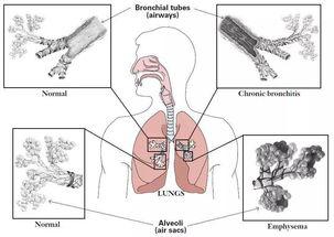 你可曾知道，有一种疾病叫慢阻肺