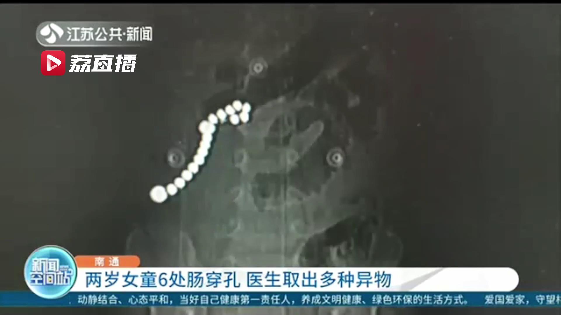 两岁女童误食致6处肠穿孔 医生手术取出15颗磁力珠、2颗钢珠及1枚螺钉