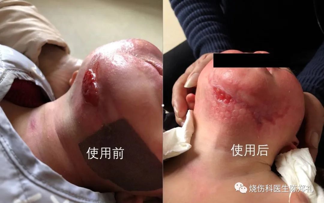 褥疮系列3：褥疮、窦道换药过程视频+图解