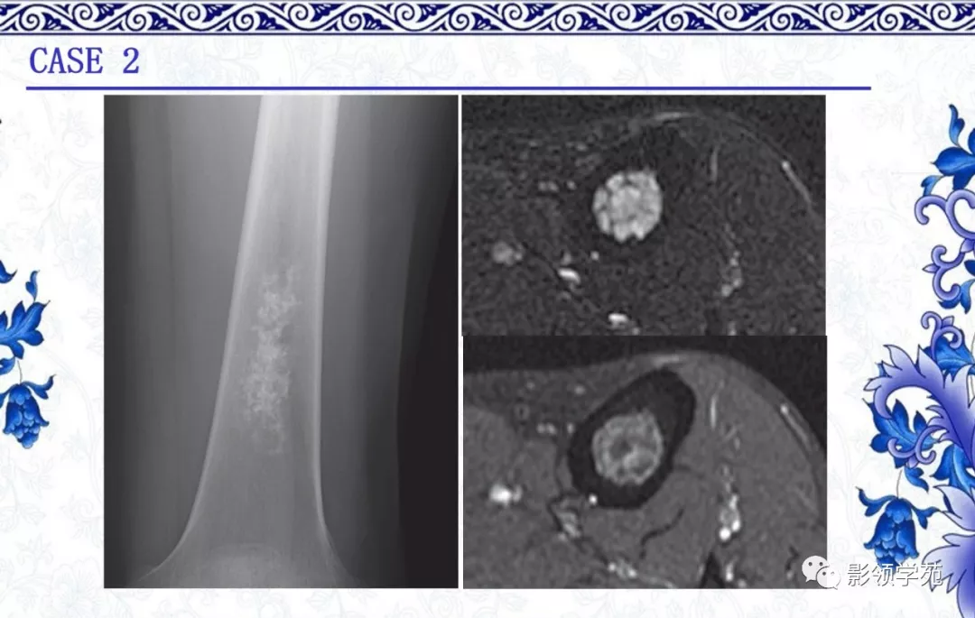 7种常见的软骨源性肿瘤的影像表现