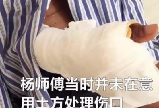 先抹|大爷烧伤后先抹盐水后抹大酱 网友：你腌肉呢？