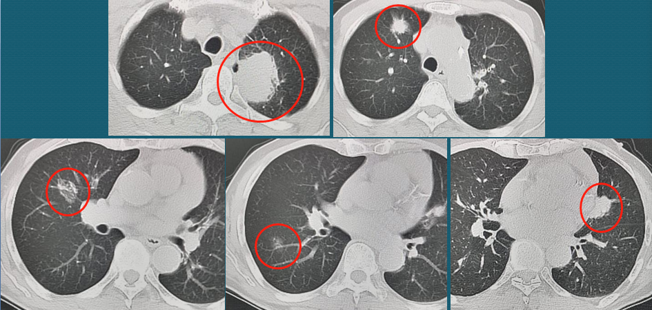 老人长5个肺癌，都不一样，有2个扩散，肺癌不能治愈吗？