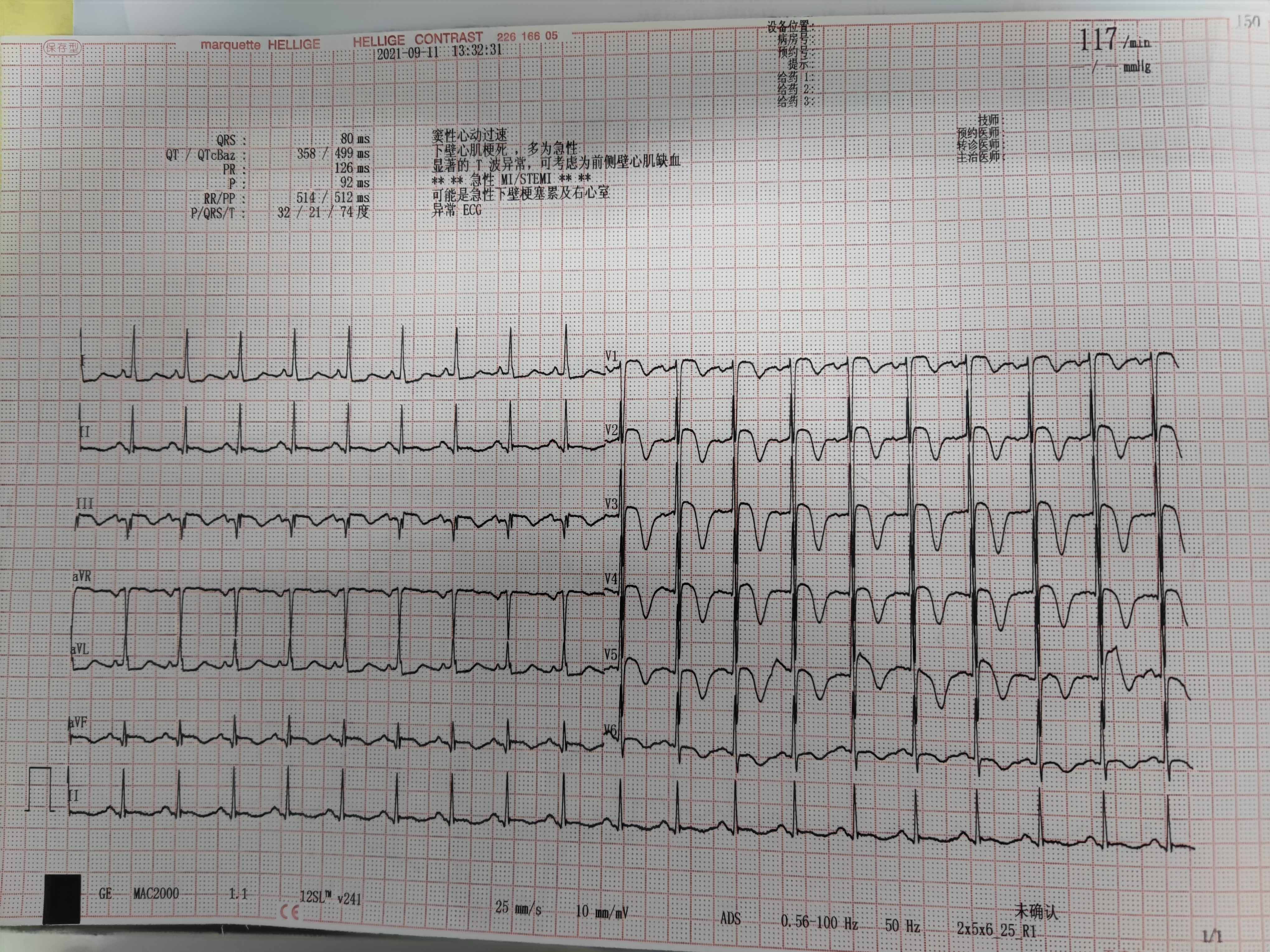 52岁女性为什么就出现这么严重的心脏病变