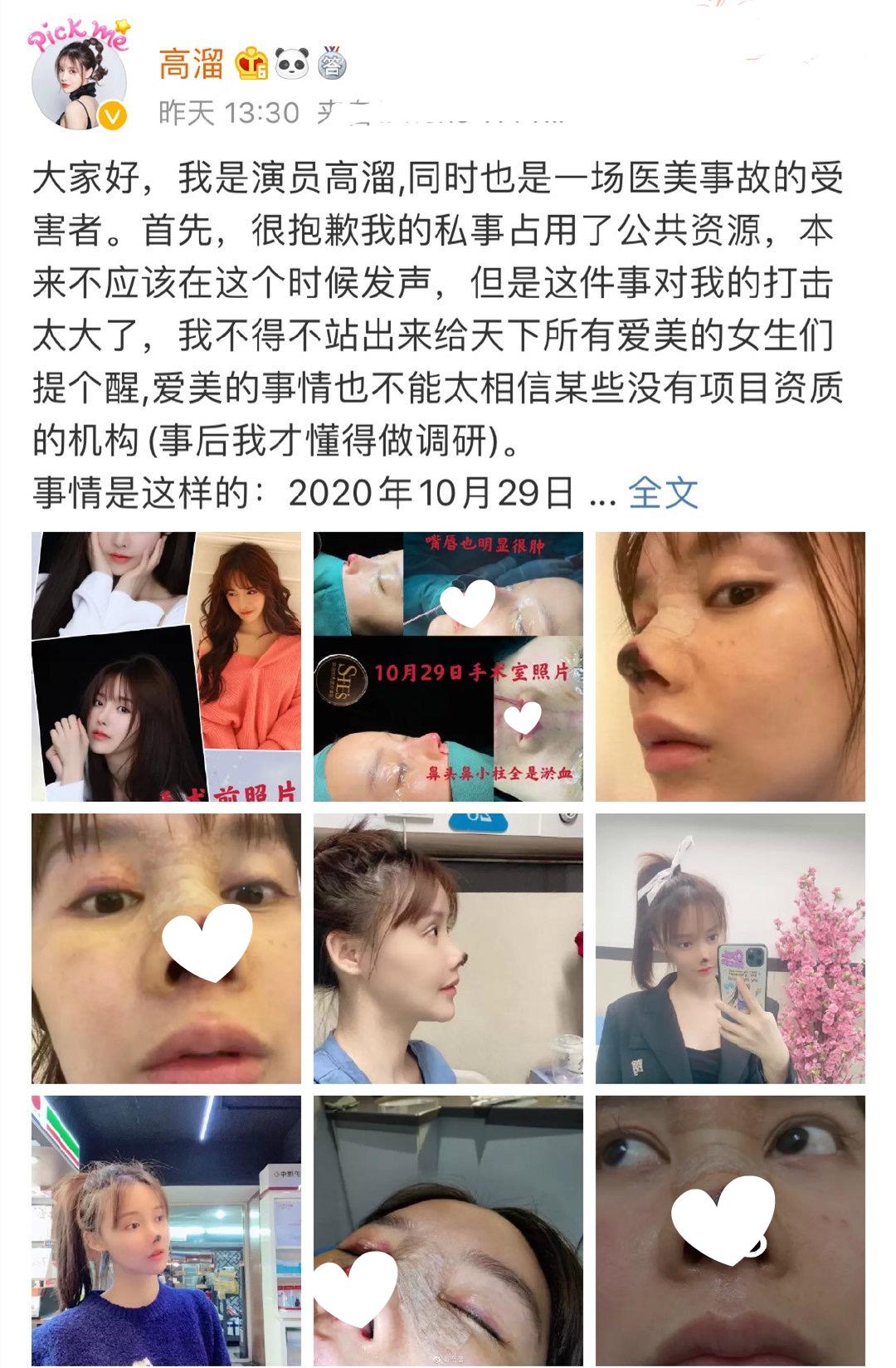 整容|演员高溜自曝整容失败鼻尖坏死！称医院无隆鼻资质 前途尽毁令其想轻生