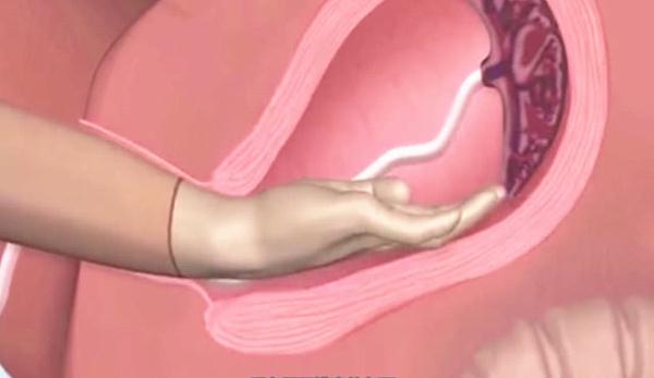 孕妇手剥胎盘有多痛，这几张3D图太真实，网友：隔着屏幕都疼