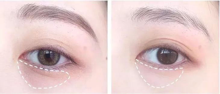 改良自《本草纲目》的护眼良方，眼睛疲惫一贴