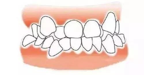 8种要矫正的牙齿畸形，看医前可对照自检