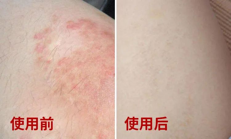 皮肤起胞水泡，奇痒难忍？用它止痒，草本配方，抑菌率99.9%