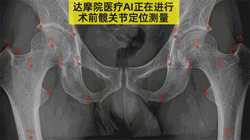 达摩院医疗AI新成果：0.3秒内完成髋关节置换手术