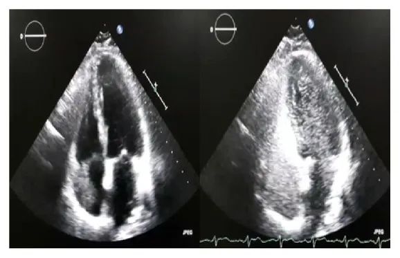 慢性丙肝患者发绀、杵状指，何因所致？｜临床实战