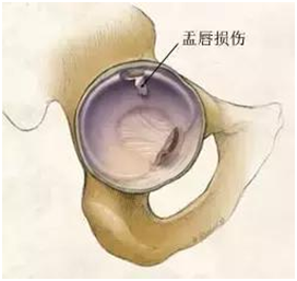 市属医院首例！泸州市中医院骨三科再添一新技术