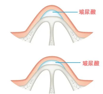 打玻尿酸，大家应该注意些什么？