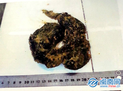 漳州一12岁女孩吃头发引发肠梗阻可能与患者的心理压力大等有关