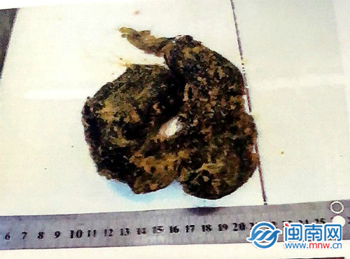 漳州一12歲女孩吃頭髮引發腸梗阻可能與患者的心理壓力大等有關