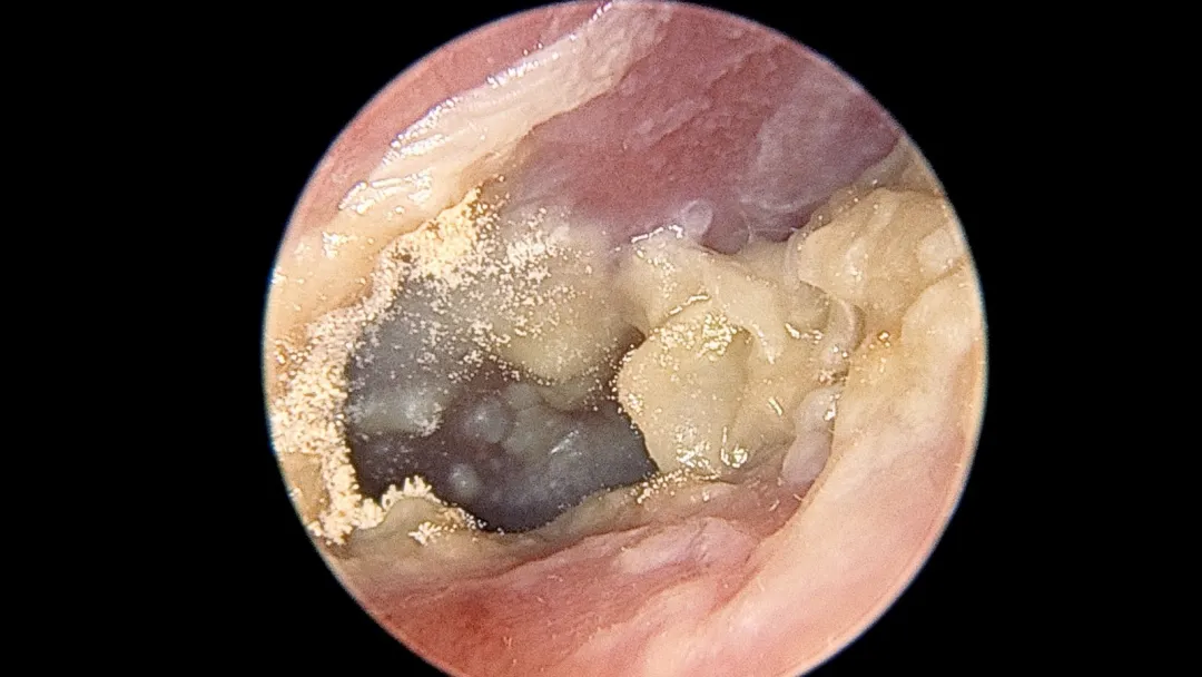 可怕 女子耳朵奇痒无比 里面竟长毛发霉 这个习惯很多人都有 健康 爆资讯新媒体平台