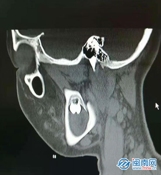 16歲女孩牙齦疼痛流膿醫院檢查發現是智齒出了問題