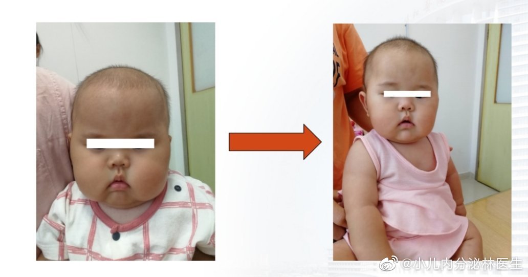 3月龄女娃重19斤满月脸，含激素宝宝霜屡被曝光官方正调查