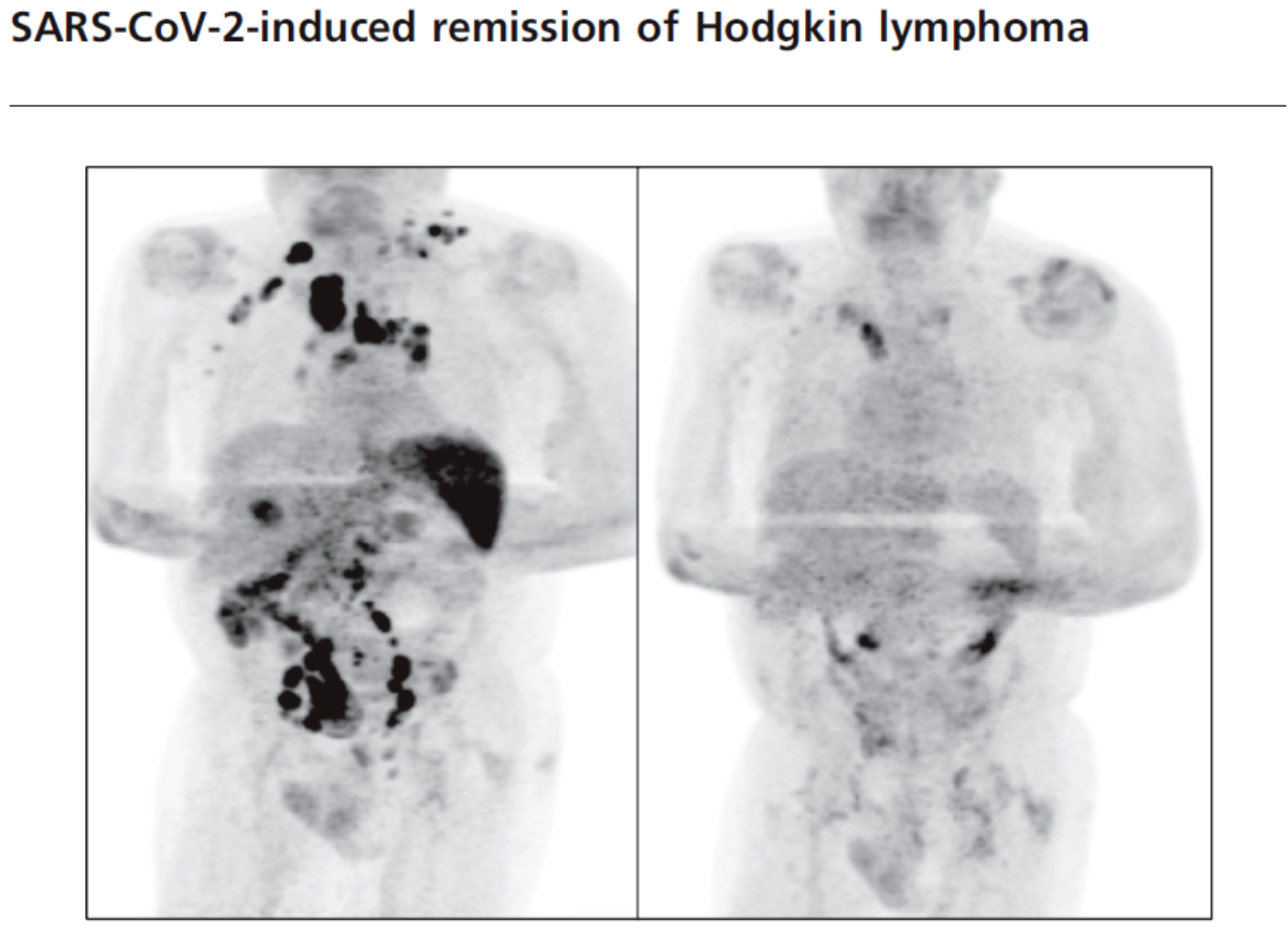 Ӣ��һ��֢�������Ӹ�Ⱦ�¹ں��������⣬����ζ��ʲô��