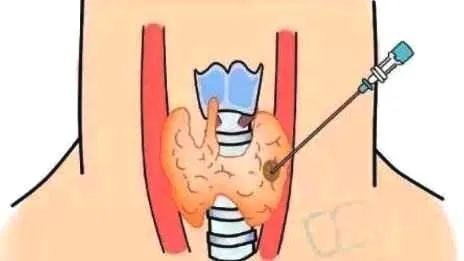 甲状腺结节良性还是恶性，检查怎么选？看这篇就够了！