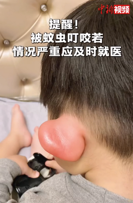男孩被蚊子叮成大耳朵图图好笑又让人心疼的一幕