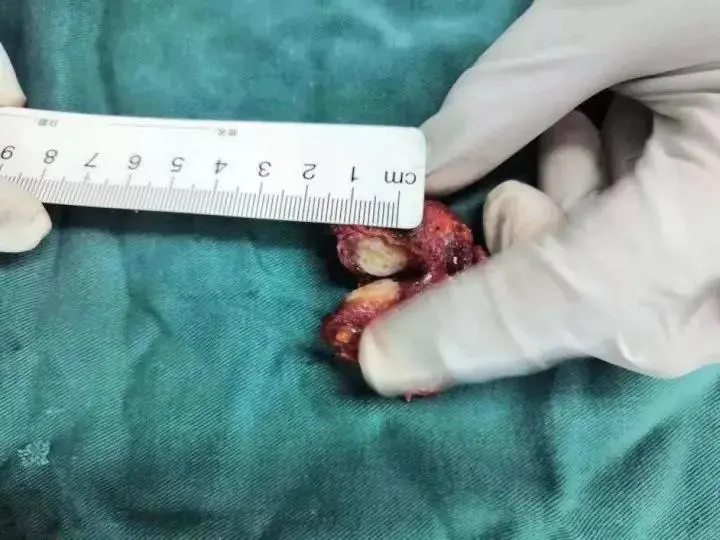 25岁姑娘入职体检时查出癌症，2年前出现症状没在意，这类人群高发