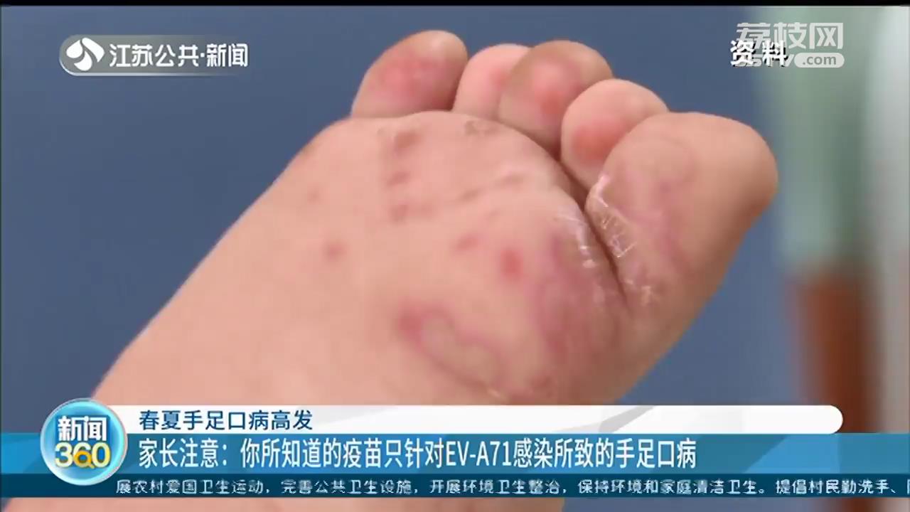 家长们注意：手足口病高发季节 这种疫苗并不能完全预防