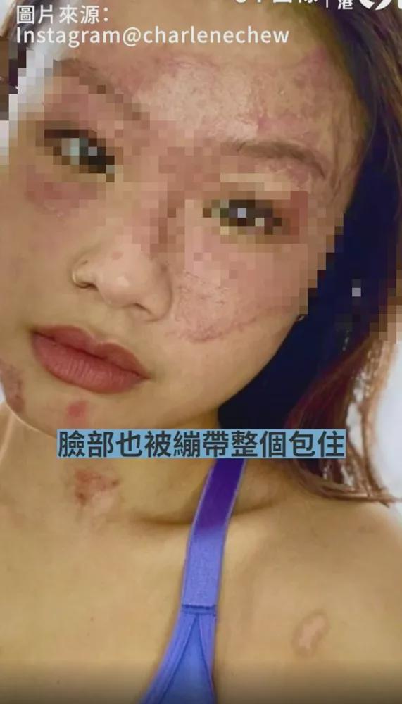 澳洲华人美女脸都炸烂了，厨房里这个行为要命，每个人都会犯