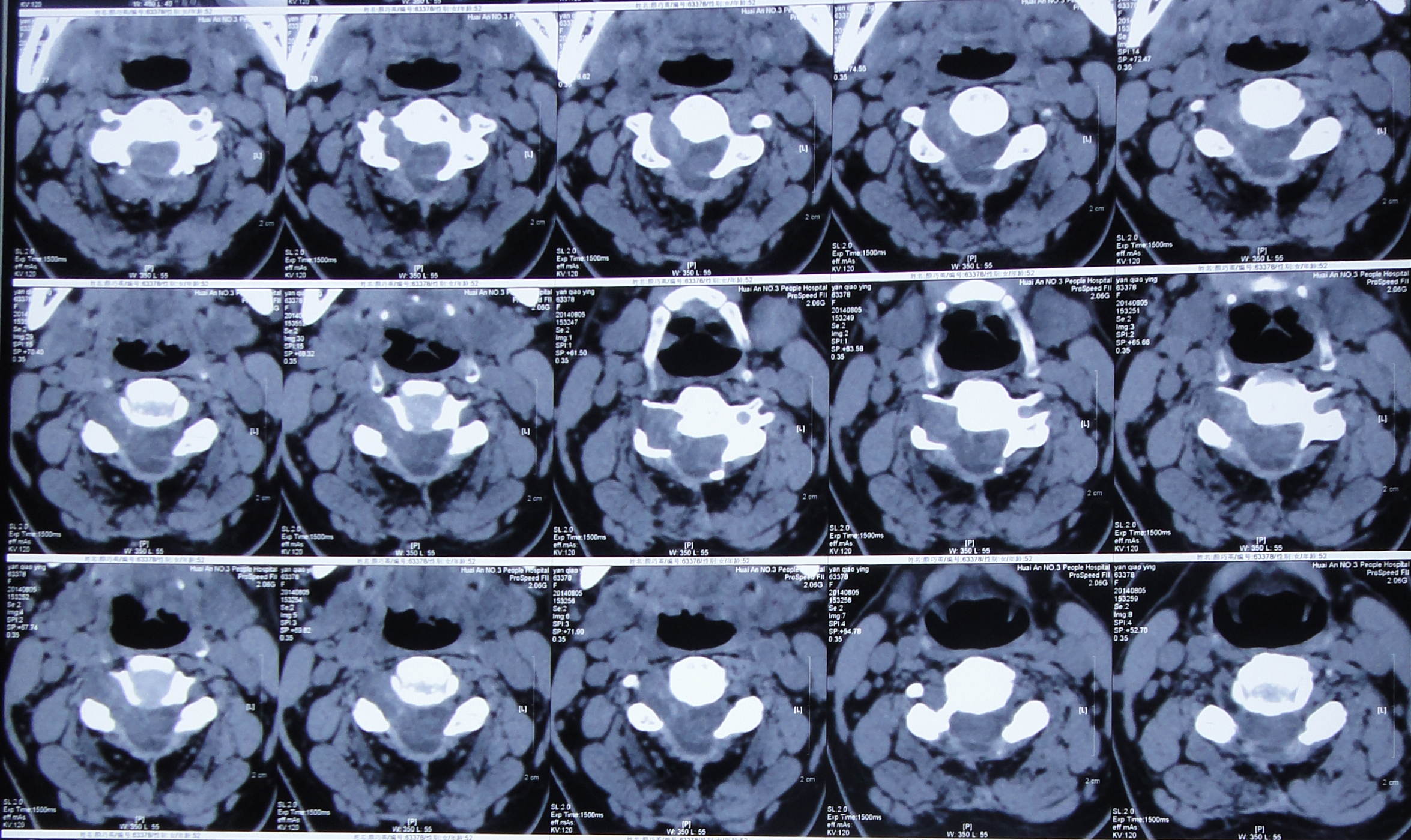 haodf:8:zhouweishenjingxitongzhongliu-->神经鞘瘤 !