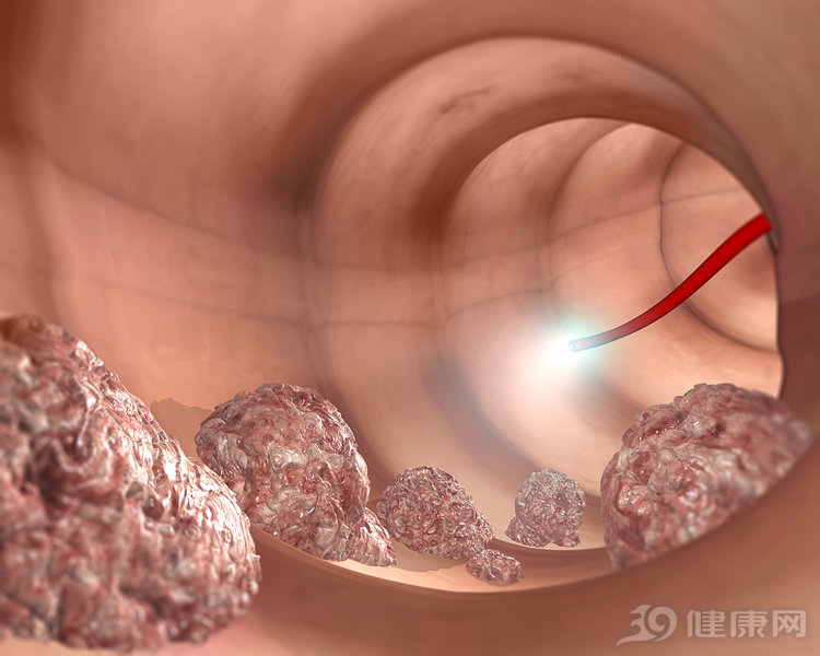 肠镜能查出早期肠肿瘤，有这10种情况的人，最好每年检查一次