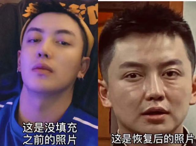 男网红整容失败 直播痛哭脂肪填充之后老了岁 前后对比没法看 柠檬味的娱乐圈 Mdeditor