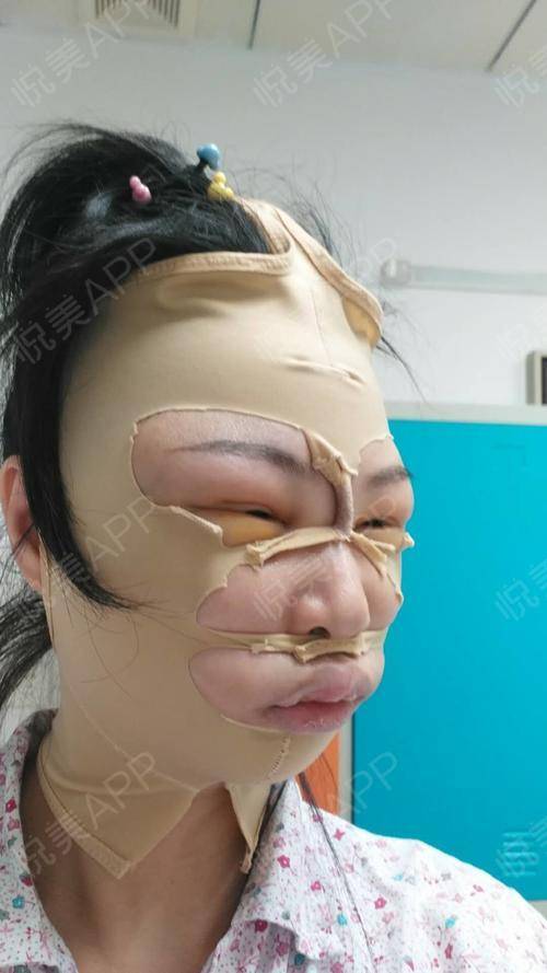 那些一刀切削骨的明星还好吗？后遗症一大堆，小方脸成最大赢家