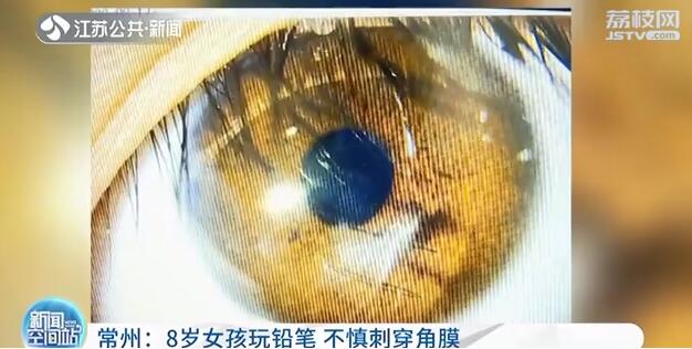 8岁女孩玩铅笔 不慎刺穿角膜